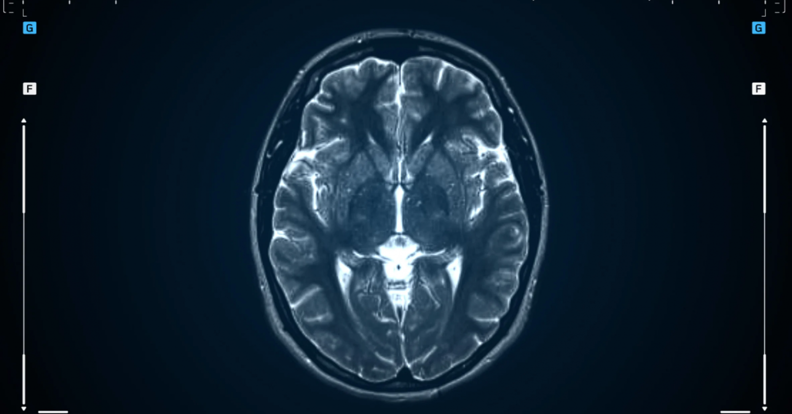 ภาพสแกนสมองจากเครื่อง MRI ใช้ตรวจหาความผิดปกติหรือมะเร็งสมอง